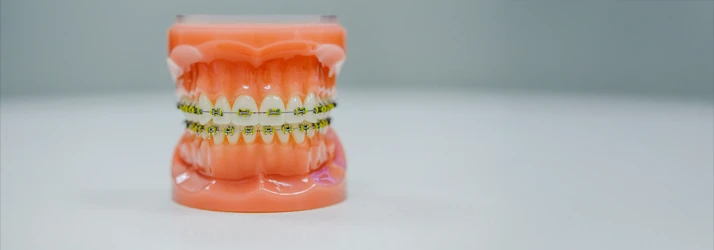 FC – Clear Braces at Wright Orthodontics in Batavia, IL FC – Clear Braces at Wright Orthodontics in Batavia, IL