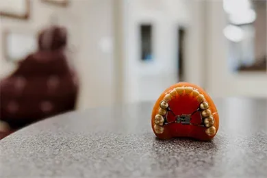 Orthodontist Batavia IL Types of Braces Early Treatment A mouth model with an expander installed to show examples of early treatment options