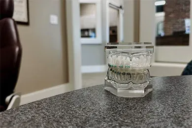 Orthodontist Batavia IL Types of Braces LightForce A mouth model to demonstrate and model LightForce braces